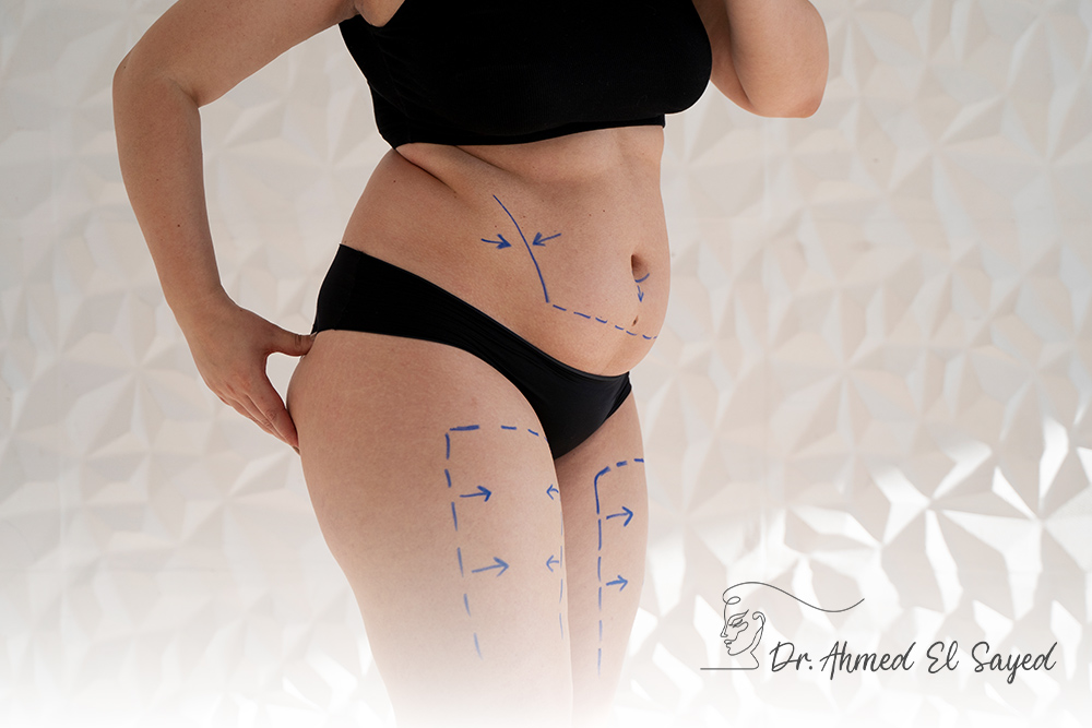 Abdominal-Liposuction-and-Ideal-Body-Contouring