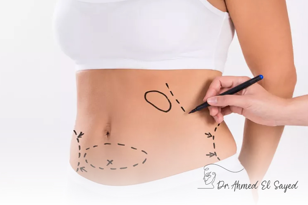 tummy-tuck