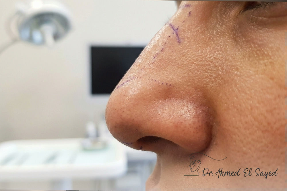Thick-skinned-rhinoplasty