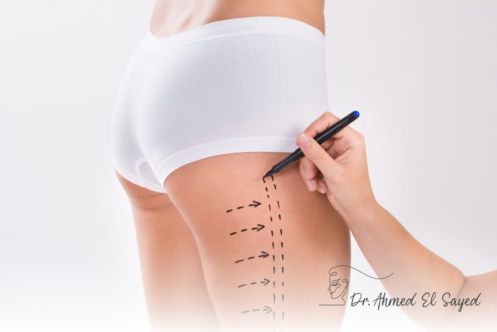 Thigh-Tightening-with-J-Plasma
