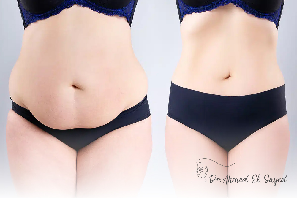 Tummy-Tuck-