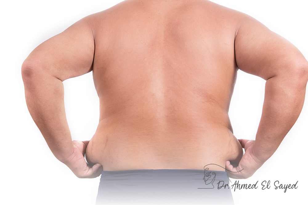 back-liposuction-surgery