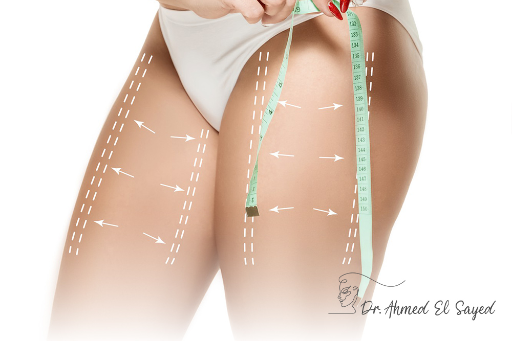 my-experience-with-thigh-liposuction