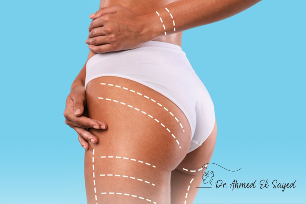 عملية-شفط-دهون-الأرداف عملية-شفط-دهون-الأرداف