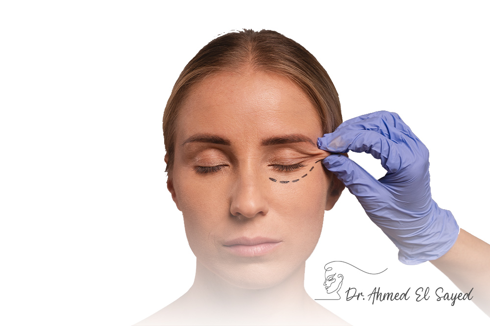 Eyelid-Surgery