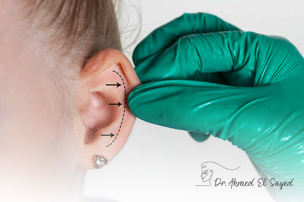 Otoplasty