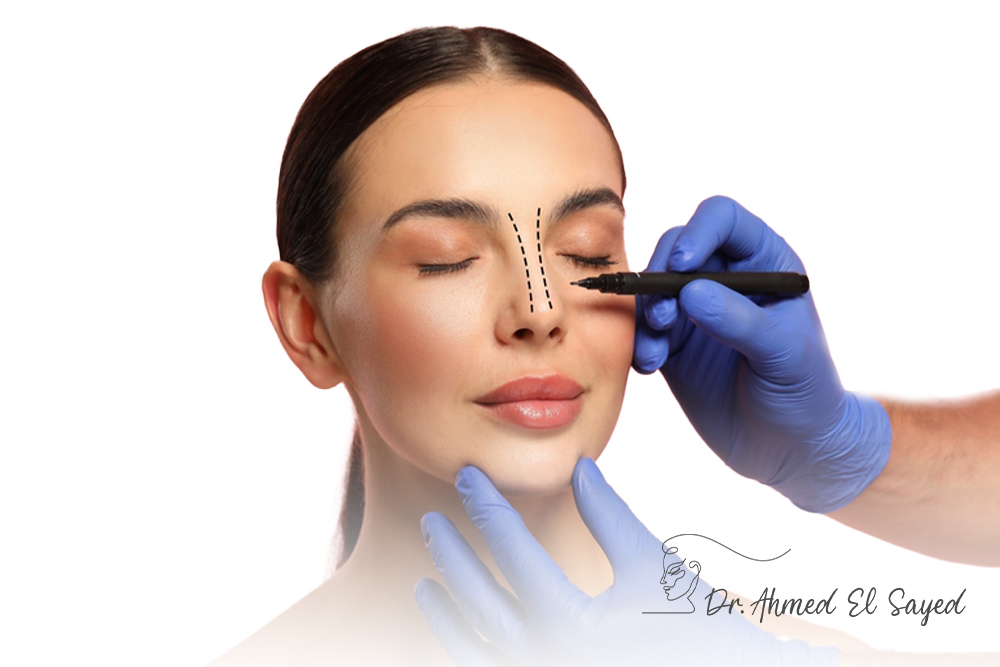 Rhinoplasty