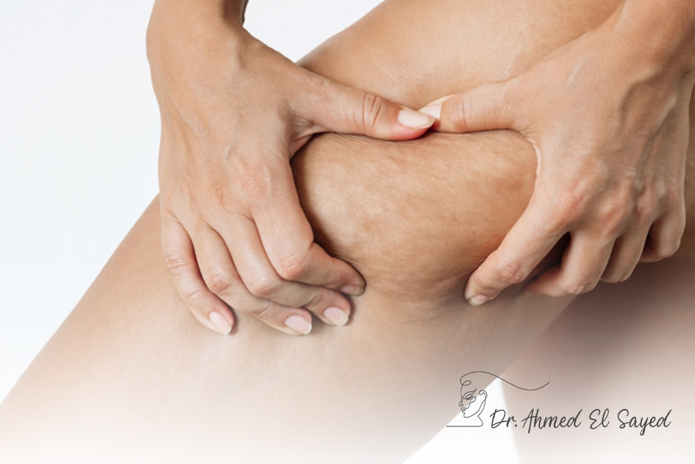 Thigh-Lift