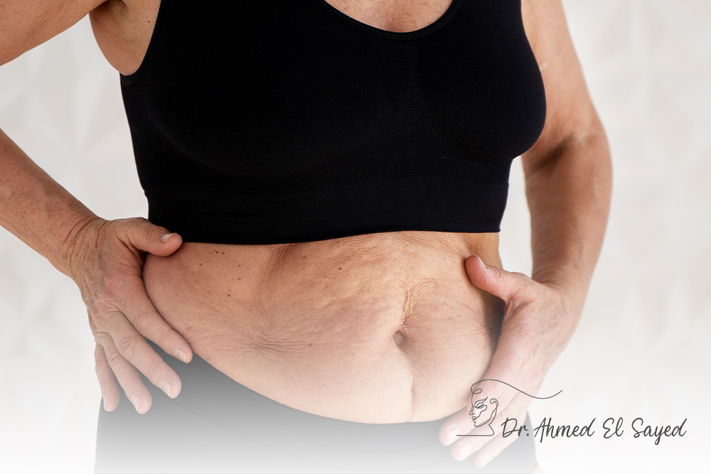 Tummy-Tuck
