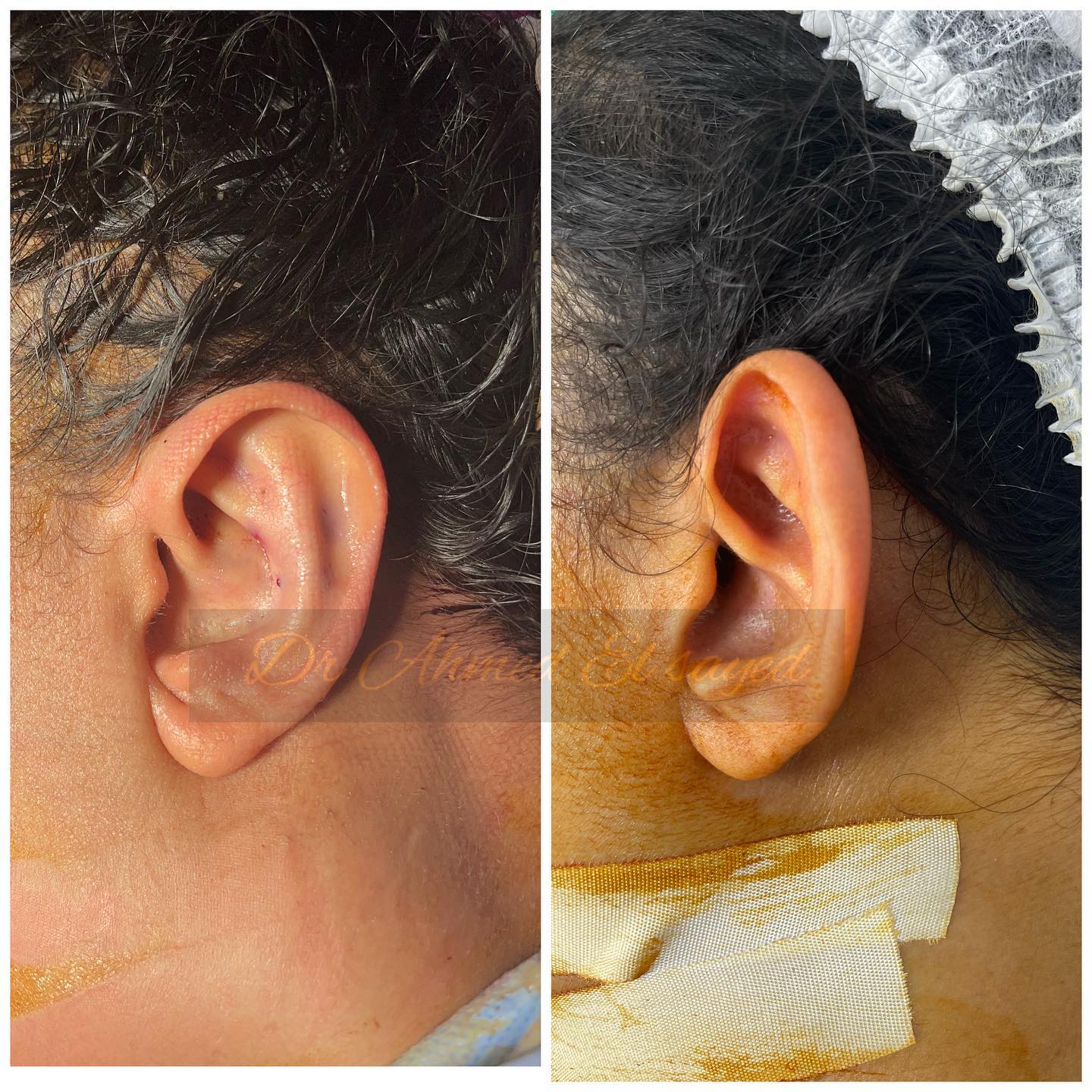 تجربتي-مع-عملية-تجميل-الأذن تجربتي-مع-عملية-تجميل-الأذن