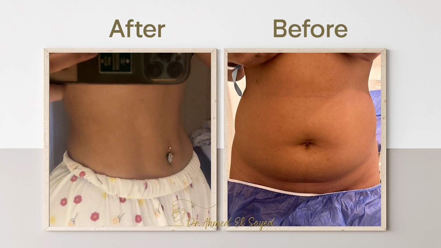 تجربتي-مع-عملية-نحت-البطن-والخصر
