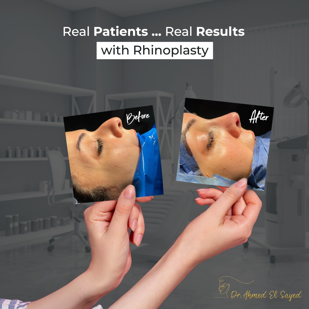 تجميل-الانف-قبل-وبعد تجميل-الانف-قبل-وبعد
