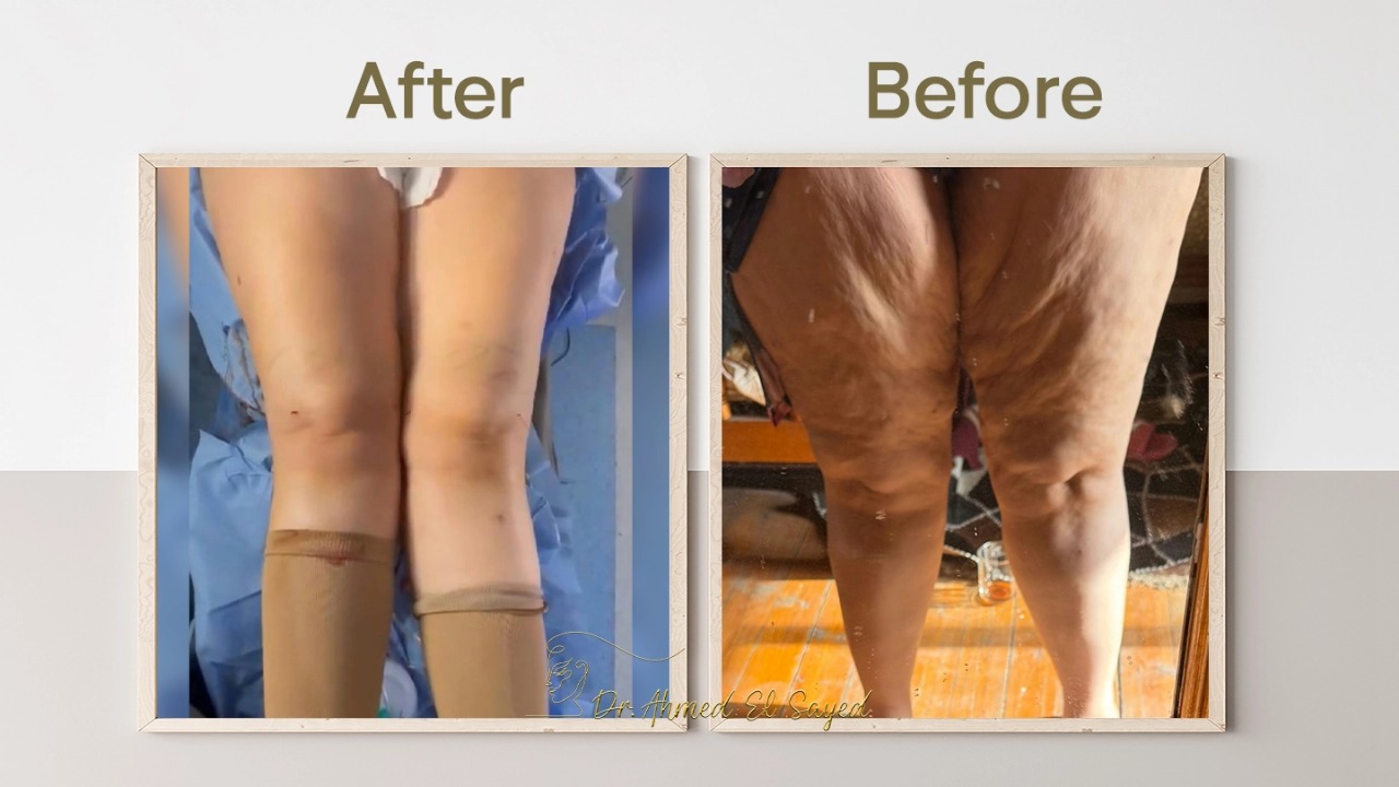 شد-ترهلات-الفخذين-والأرداف-بسرعة