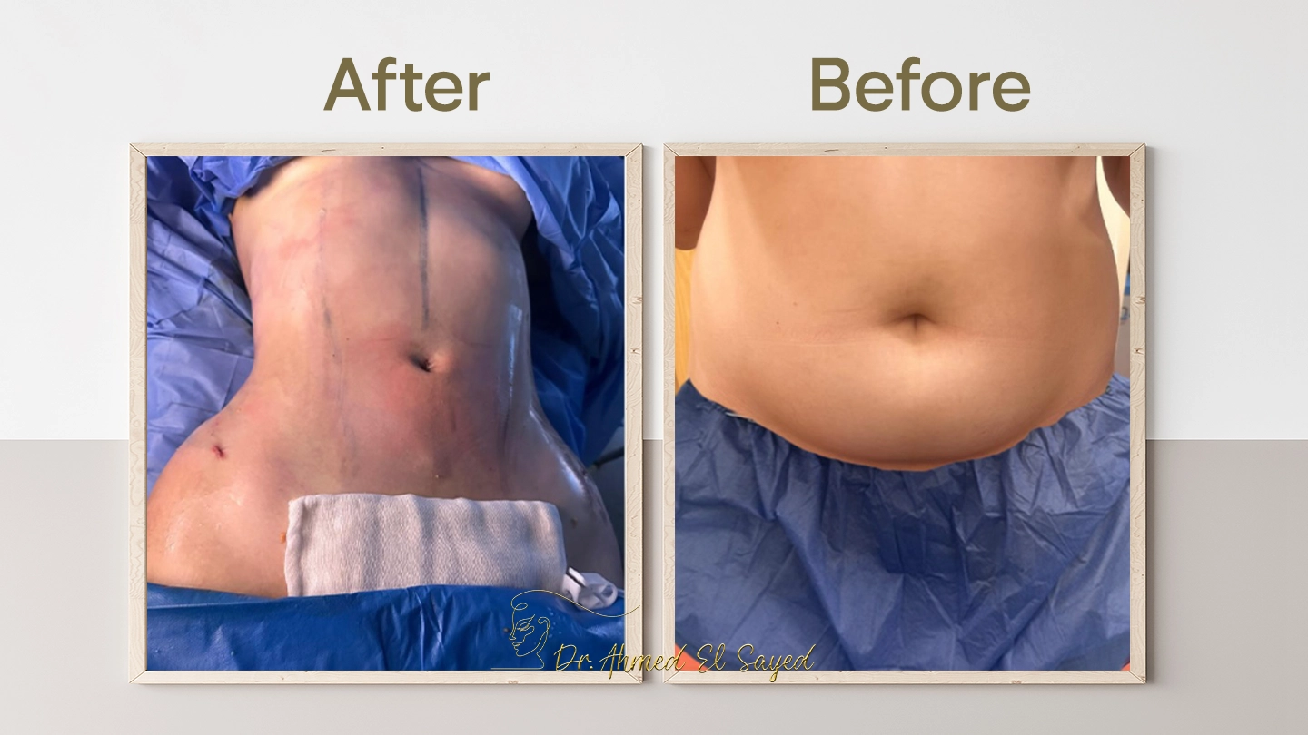 نتائج-نحت-البطن-والخصر