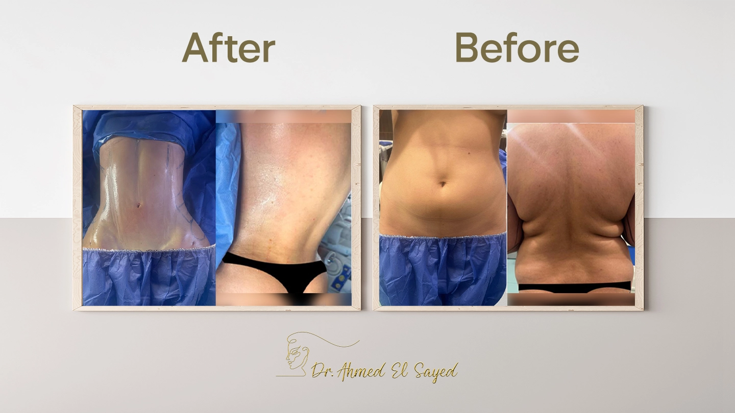 نتائج-نحت-البطن-والظهر